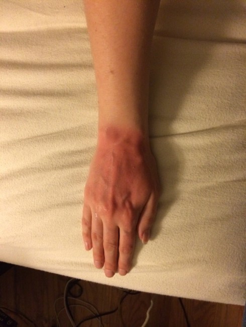 First sunburn of 2014.